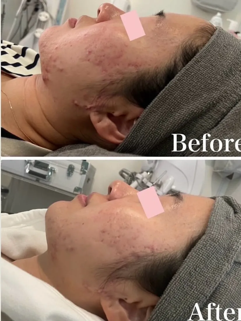 ＼ 剥けても剥けなくても、肌は変わる 🌿 ／