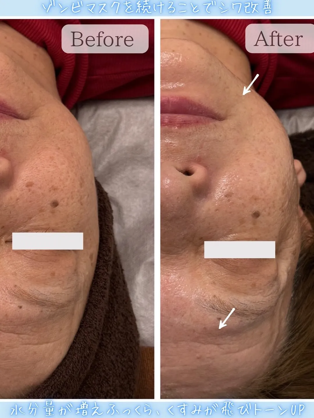 ハイドロスプラッシュ毛穴洗浄×ゾンビマスク🧟‍♂️