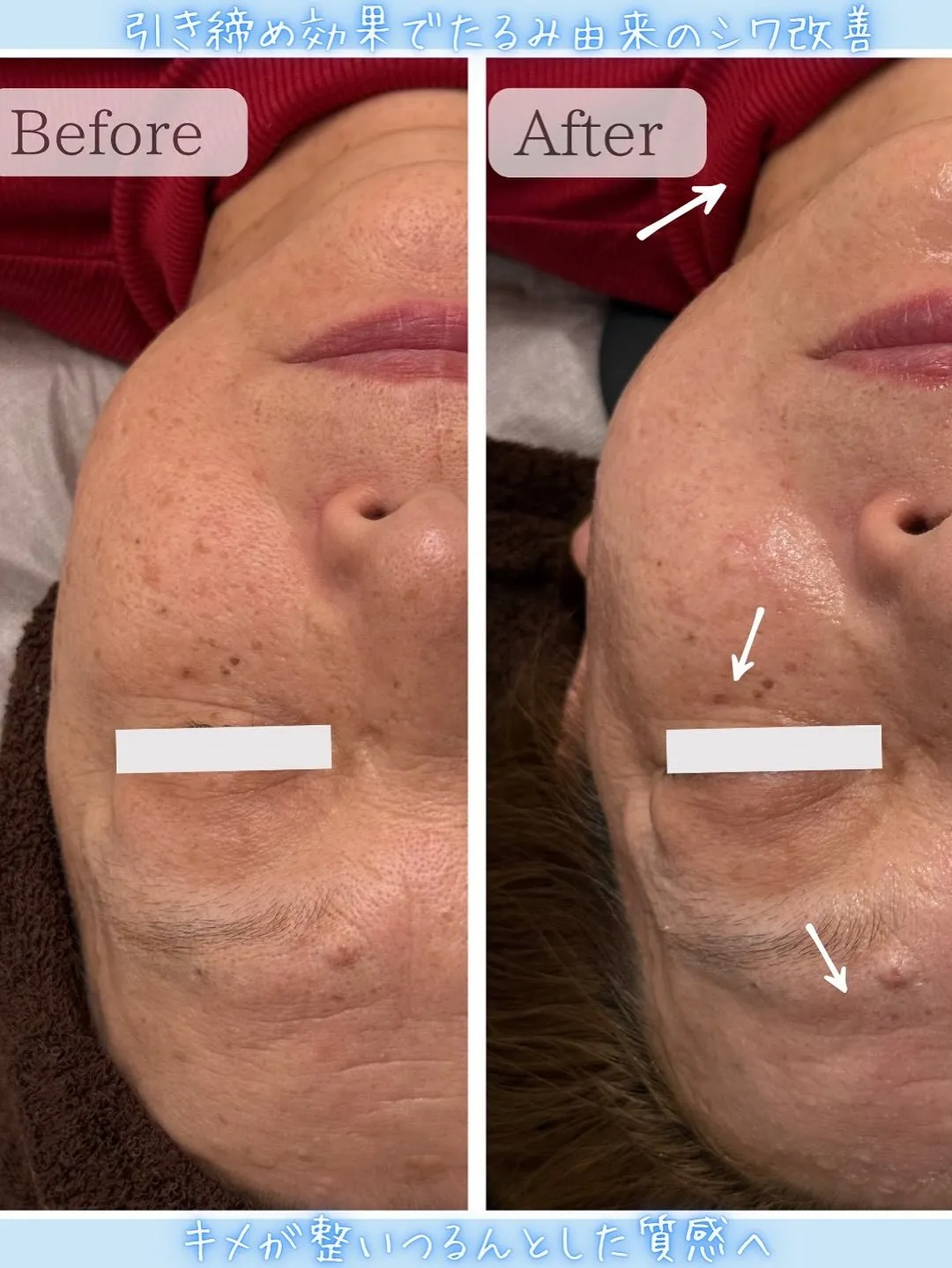 ハイドロスプラッシュ毛穴洗浄×ゾンビマスク🧟‍♂️